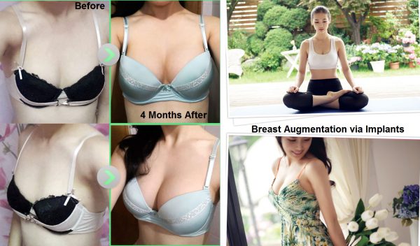 Breast Augmentation - Incision Types - Seoul Guide Medical