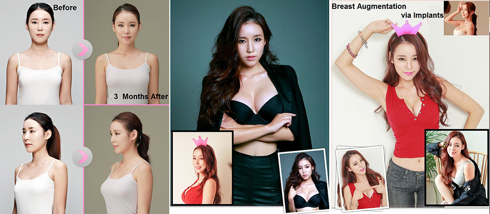 breast augmentation and implants in seoul, korea at dodream plastic surgery